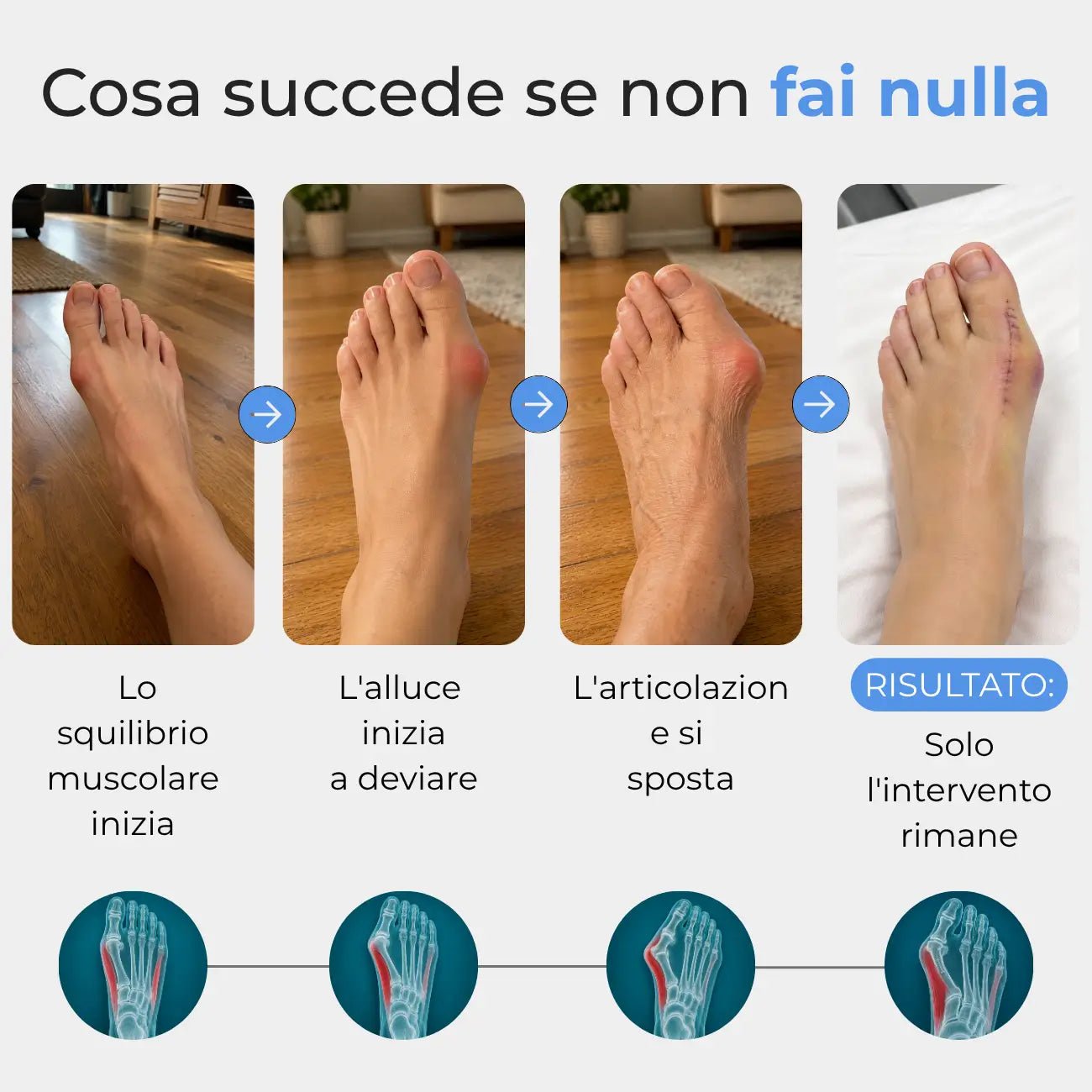 Stridewell™ — Correttore per Alluce Valgo